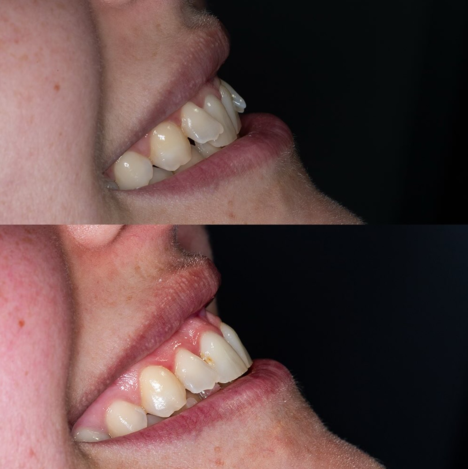Πριν και μετά κλείσιμο diastema και ευθυγράμμιση crowding — Clear Aligner Θεσσαλονίκη