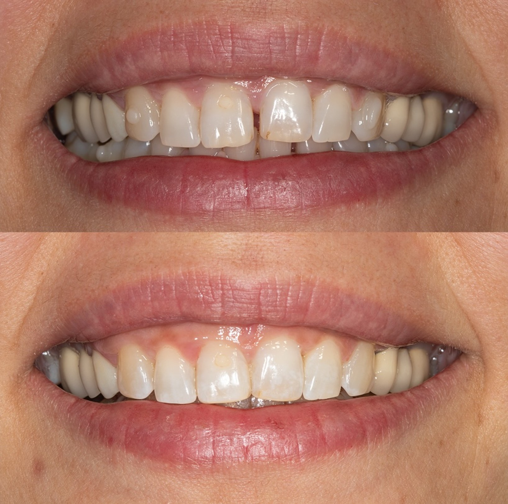 Πριν και μετά κλείσιμο diastema και ευθυγράμμιση crowding — Ορθοδοντική Θεσσαλονίκη